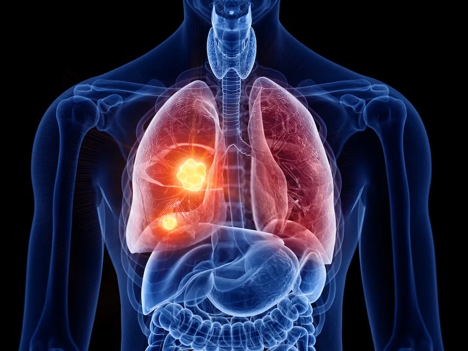 3d rendered medically accurate illustration of lung cancer