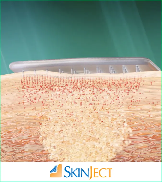 Medicus Pharma SkinJect Patch applied locally to BCC lesion