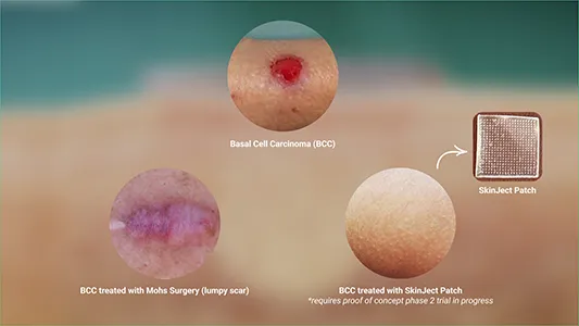 Medicus Pharma - SkinJect vs Mohs Surgery